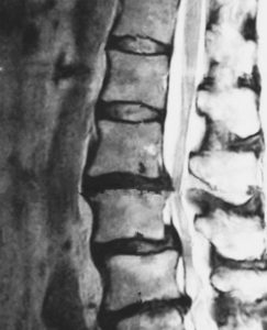 椎間板ヘルニアが原因となっている脊柱管狭窄症のMRI画像