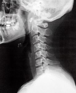 頚椎のレントゲン画像