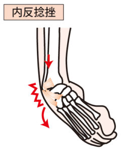 右足関節内反捻挫の画像です。