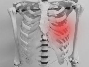 肋骨骨折は咳やクシャミなどの外力でも骨折を起こすことがあります