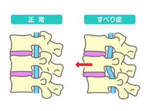腰椎すべり症